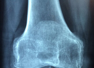 Osteoporoza
